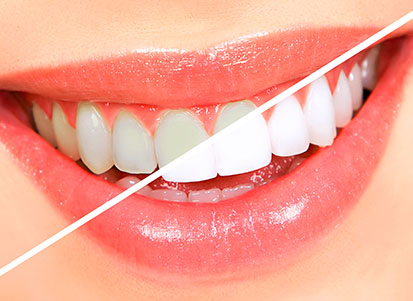 blanqueamiento dental clinica dental ibiza
